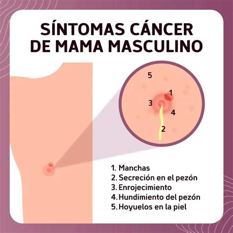 C Ncer De Mama En Hombres Una Enfermedad Neopl Sica Poco Frecuente Radio Lautaro