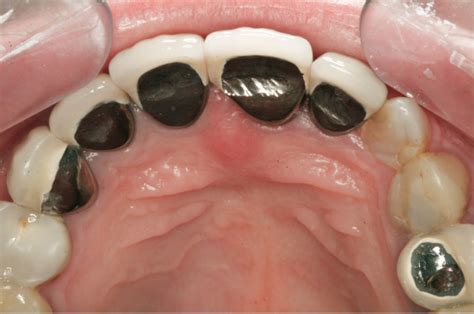 These are both effective crown materials. Porcelain Fused To Metal Crowns Problems - slidedocnow