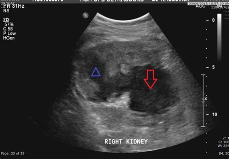 Cureus A Renal Colic Mimic Wunderlich Syndrome A Case Report