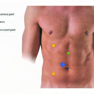 Robotic Pyeloplasty Trocars Placement Download Scientific Diagram