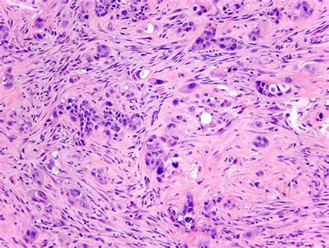 Maybe you would like to learn more about one of these? Malignant pleural mesothelioma subtypes