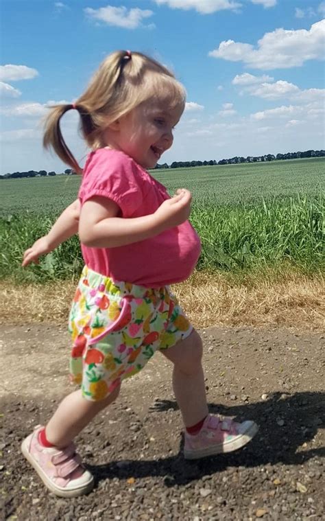 Meet The Inside Out Little Girl Who Was Born With Her Stomach Liver