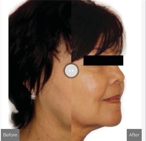 Skin Tightening Wrinkle Reduction Anti Wrinkle Services In Chicago