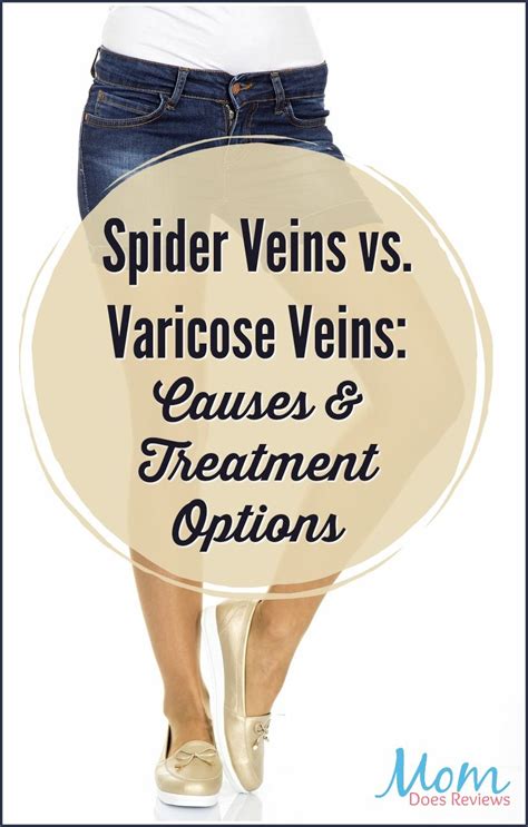 Spider Veins Vs Varicose Veins Causes And Treatment Options Artofit