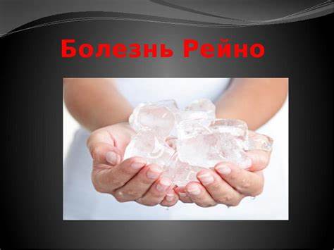 Рейно болезнь диета Болезнь Рейно - презентация, доклад, проект Болезнь Рейно - презентация, доклад, проект Рейно болезнь диета