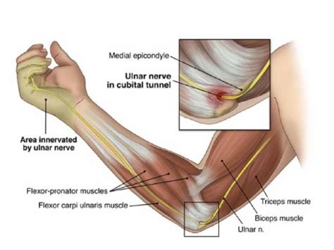 Endoscopic Cubital Tunnel Syndrome Release Dr Jonathan Lee Yi Liang