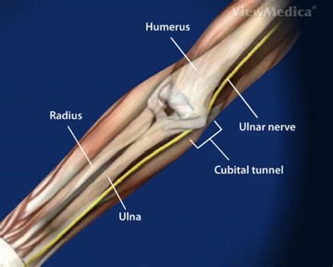 Cubital Tunnel Syndrome Doctor Los Angeles Cubital Tunnel Syndrome