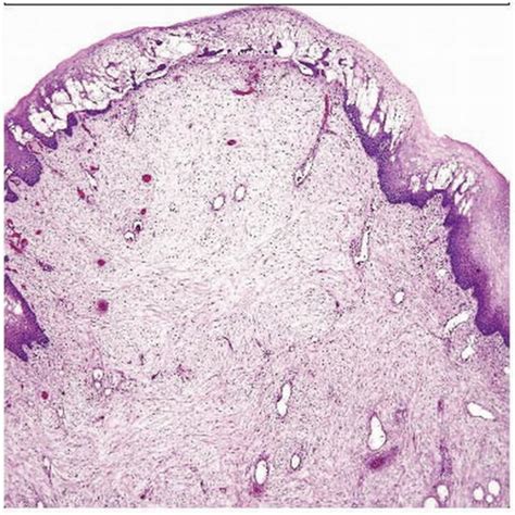 Fibroepithelial Stromal Polyp Basicmedical Key