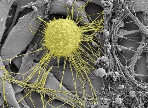 Cancer Cells Under Electron Microscope Micropedia