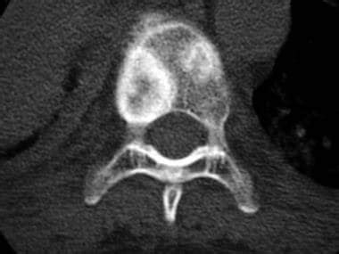 Imaging in Bone Metastases: Practice Essentials, Radiography, Computed