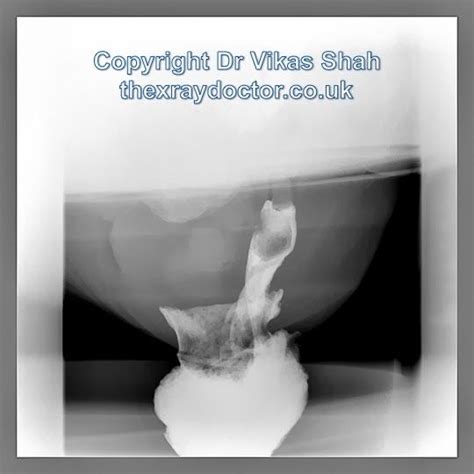 From My Website The Xray Doctor Pelvic Floor Imaging Part What Is A Rectal Prolapse A