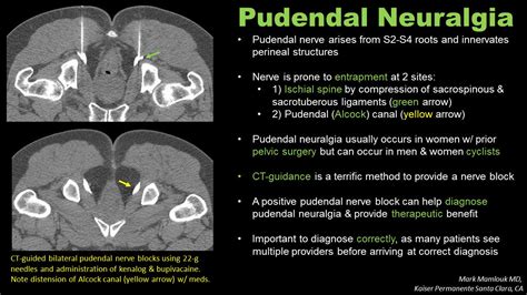 Pudendal Neuralgia Pudendal Nerve Arises From S2 S4 Grepmed