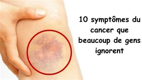 Symptômes, définition , diagnostic, traitements animation permettant de comprendre les symptômes précoces, l'évolution de si vous venez pour la première fois avec les signes cités plus haut, que vous êtes fumeur à plus de 40 ans, il sera tenté de vous donner dans un. Voici quelques-uns des symptômes du cancer: Dès que vous ...