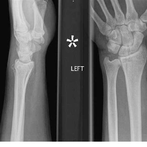 A Fracture Of The Tip Of The Ulnar Styloid With A Stable Dru Joint