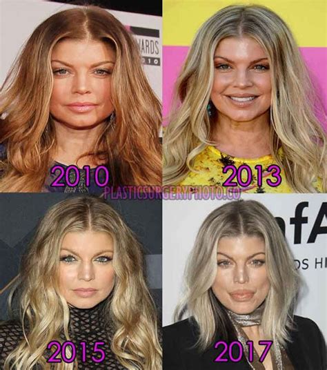 Fergie After Plastic Surgery Photos Celebrity Plastic Surgery