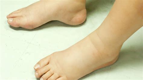 Watch Now 7 Tips To Treat Swollen Feet In Diabetics Health Tips