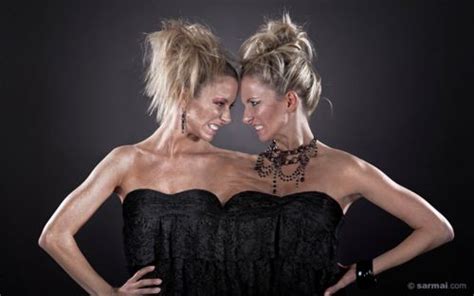 Livia And Emese Nagy Inspiring Conjoined Twin Models