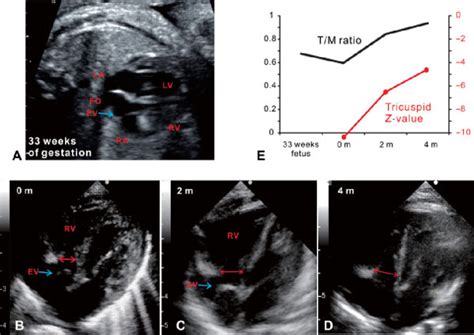 Hypoplastic Right Ventricle And Tricuspid Valve And Postnatal