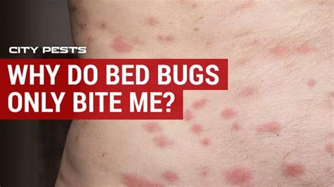 Why Do Bed Bugs Only Bite Me And Not Everyone City Pests