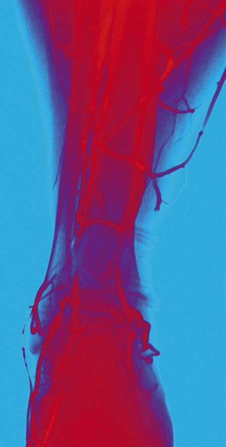 Normal Leg Veins Angiogram Photograph By Miriam Maslo Fine Art America