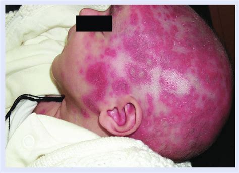 Neonatal Cutaneous Lupus A Nonscarring Rash In A Photosensitive