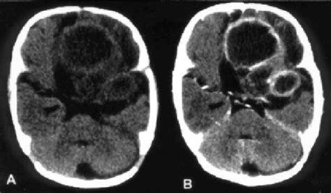 Initial Unhanced Ct Scan A And After Iodine Contrast Enhancement B
