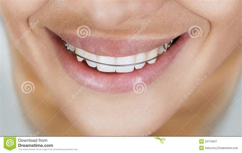 frenillos ortodoncia re movible protesis dentales ortodoncia dental
