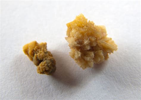 Check spelling or type a new query. Kidney Stones: Causes, Symptoms & Treatment | Live Science