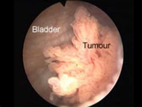 Bladder cancer is most frequently diagnosed by investigating the cause of bleeding in the urine that a patient has noticed. Tumor de bexiga - Cancer bexiga - Cancer de bexiga ...