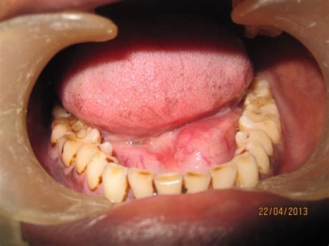 Intraoral Photograph Showing Swelling In The Floor Of The Mouth