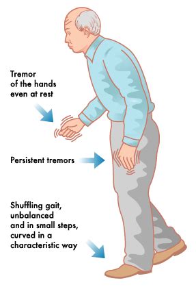 Parkinson's symptoms usually begin gradually and get worse over time. Parkinson's Disease - Legacy Spine & Neurological Specialists