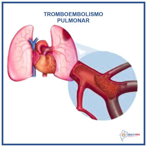 Tromboembolismo Pulmonar TEP SBACVMA