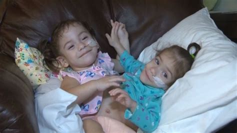Conjoined Twins Separated After 17 Hour Surgery In California Nbc 7