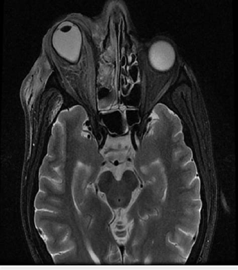 Mri T2 Brain Axial View The Image Shows Right Orbital Cellulitis And