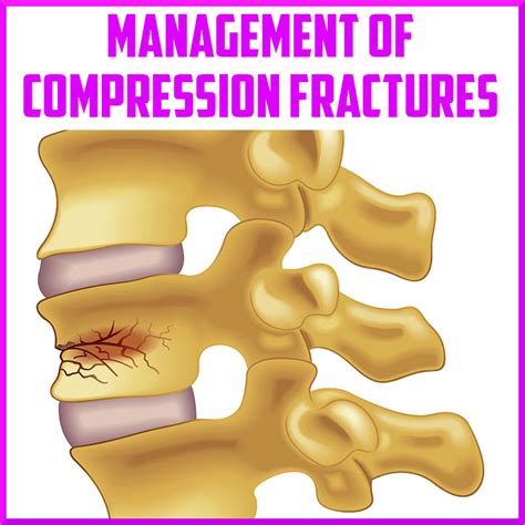 Management Of Osteoporotic Vertebral Compression Fractures Tips Tricks