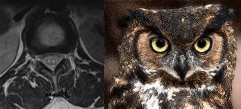 Owl Eyes Sign T2w Axial Mri Of The Dorsal Spine Depicting Bilateral