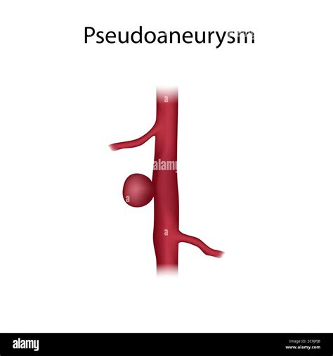 Pseudoaneurysm Illustration An Aneurysm Is A Blood Filled Dilation In