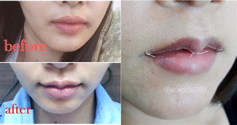 Asian Women Are Now Getting Surgery To Have Thinner Caucasian Lips