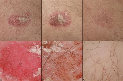 A A Psoriatic Lesion At Baseline T0 B No Clinical Response Is