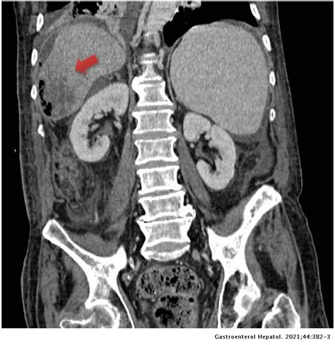 Unusual Complication After Chemoembolisation Of Hepatocellular