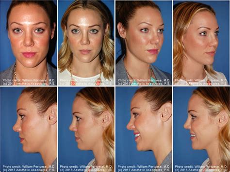 Saddle Nose Before And After Photo Gallery Nose Surgery Photos