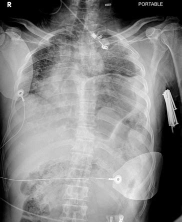 Traumatic Diaphragmatic Rupture Radiology Case Radiopaedia Org