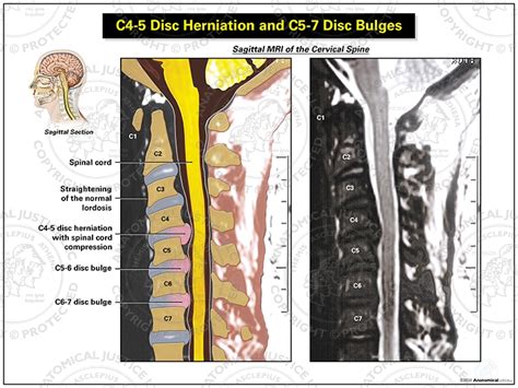 C4 5 Disc Herniation And C5 7 Disc Bulges