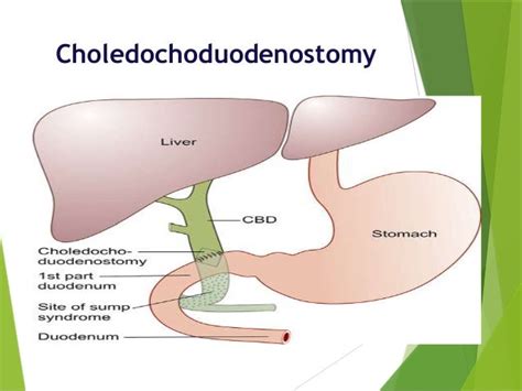 Choledocholithiasisone Step Ahead