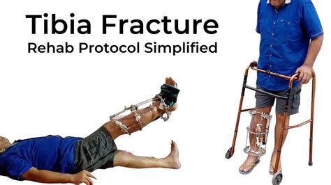 Physiotherapy After Tibia Fracture Surgery Leg Bone Fracture Exercises