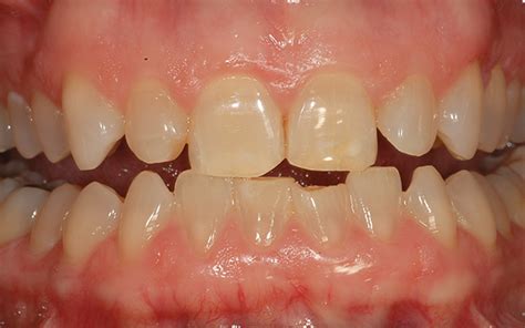Bleaching Tetracycline Stained Teeth January 2018 Inside Dentistry