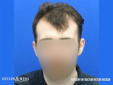 Hair Transplant Photos Hair Transplant Before And After