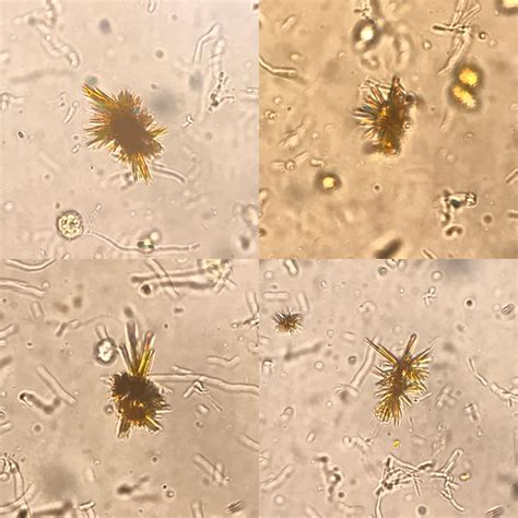 Bilirubin Crystals In Urine From A Patient With Alcoholic Cirrhosis R