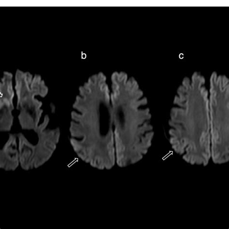 Diffusion Weighted Magnetic Resonance Imaging From 4 Months After The