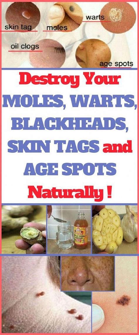 Destroy Your Moles Warts Blackheads Skin Tags And Age Spots Completely